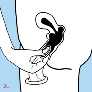 Many women prefer to use the female condom for contraceptive purposes and for protection against sexually transmitted infections. These non-latex (polyurethane) condoms are suitable for use with water based personal lubricants