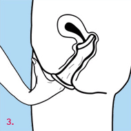 The Femidom is a lubricated condom for women. It is an effective method of contraception which protects against both pregnancy and sexually transmitted infections (STIs).